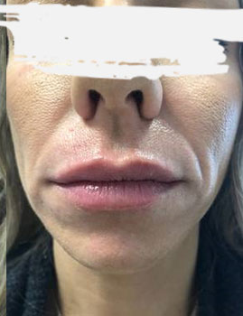 Juvederm Lips After