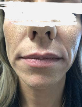 Juvederm Lips Before