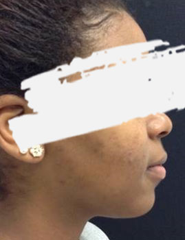 Microneedling Cheek After
