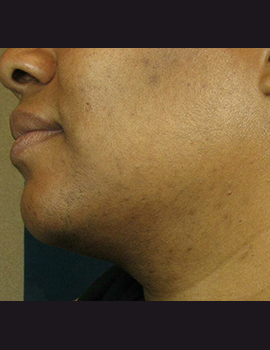 After Laser Hair Removal