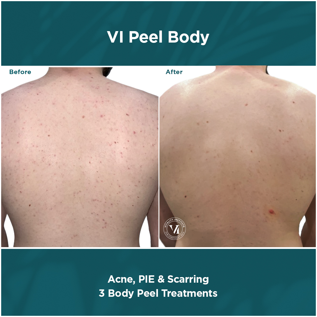 Chemical Peel In Atlanta